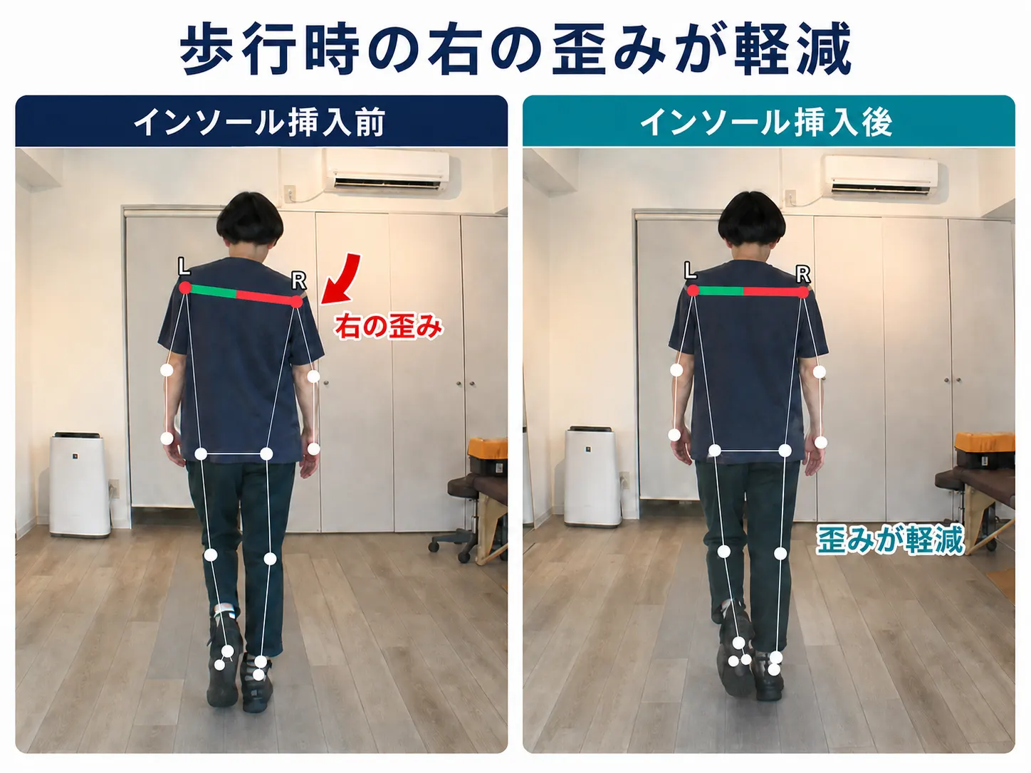 インソール挿入前と挿入後の歩行比較。挿入前は右肩が下がる歪みがあり、挿入後は歪みが軽減している